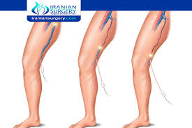 Your doctor may also ask you to describe any pain and aching in. Varicose Veins Complications Varicose Vein Surgery Complications