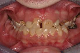 Your dentist will drill away the decayed portion of the tooth and replace it. Vaping And Oral Health It S Worse Than You Think Perio Implant Advisory
