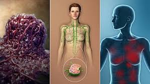 Stage 4 cancer is simply a level that measures how far the cancer has progressed in your. Cancer Staging Wikipedia