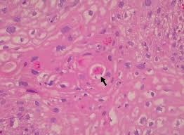 The bumps contain keratin, a protein that occurs naturally in human skin, hair, and nails. Cureus A Rare Variant Of Penile Squamous Cell Carcinoma In A Man With Paraplegia