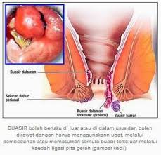 Buasir atau hemoroid adalah penyakit yang terjadi pada bahagian dubur. Ubat Tradisional Buasir Paling Mujarab