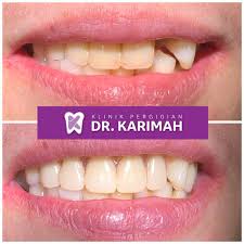 Harga veneer gigi tidaklah mahal mana. Klinik Pergigian Dr Karimah Beitrage Facebook