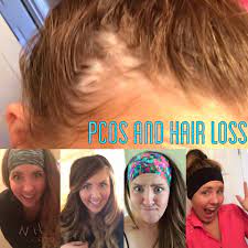 Pcos Hair Loss And Amazing Headbands Surviving Shelby Pcos Hair Loss Hair Loss Hair Loss Women