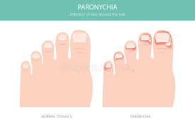 Image result for Paronychia feet