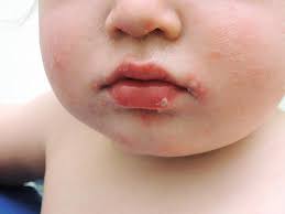 What is hand, foot, and mouth (hfmd) disease? Hand Foot And Mouth Disease Springerlink