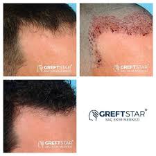 Pin Af Greft Star Pa Sac Ekimi Samsun