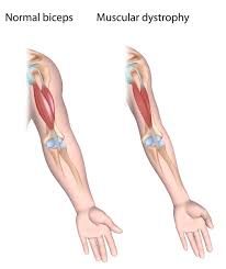 Originates from the soleal line of the tibia and proximal fibular area. Tibial Muscular Dystrophy Medlineplus Genetics