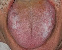 Image result for lichen planus on tongue)