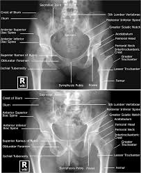 You've got the upper region, the superior part of the pelvic going back to the ischium, if you remember the lateral view, the anteroinferior part is the pubis. View Of Anterior And Posterior Pelvic Bone Vtwctr