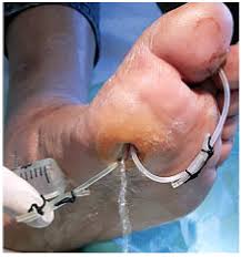 Image result for phlegmon of hand)