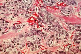 Cancer hashtags (to copy and paste) on instagram to raise more awareness online. Breast Cancer Cells Starve For Cystine Duke Today
