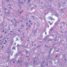 We did not find results for: Epithelioid Mesothelioma Epithelial Cell Prognosis Treatment