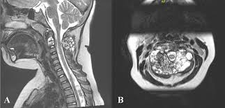 The term aneurysmal refers to the explosive, expansile nature of the. Aneurysmal Bone Cyst In The Cervical Spine Bmj Case Reports