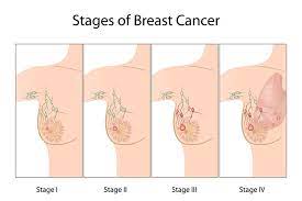 Doctors also use a cancer's stage when talking about survival statistics. Cancer Staging Ausmed