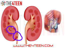What Is Kidney Stone And Types Of Kidney Stones Calcium Stones Business Investment Medical Science