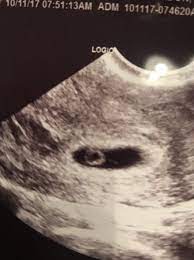 Get a free return if your baby is not cooperating. 6 Week Pregnancy Ultrasound Heartbeat Novocom Top