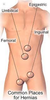 Sliding hiatal hernia, which makes up 95% of all hiatal hernias, is the bulging of a part of the esophagus and the stomach in the chest cavity, causing heartburn and. Epigastric Hernia What Is It Symptoms Causes Prevention And Treatment Top Doctors