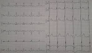 Image result for Flecainide Overdose