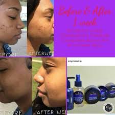 Biore Charcoal Pore Strips Before And After Black Soap Face Toner Moisturizer Before And After Turmeric Mask Activated Charcoal Toner For Face Turmeric Mask Skin Care