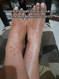 Image result for flea bites