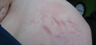 لماذا سمي خط غرينتش بهذا الاسم. Ø¸Ù‡ÙˆØ± Ø®Ø·ÙˆØ· Ø­Ù…Ø±Ø§Ø¡ Ø¹Ù„Ù‰ Ø§Ù„Ø¬Ù„Ø¯ Ø­ÙŠØ§ØªÙƒ