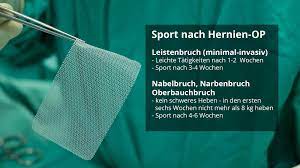 Wann Darf Man Nach Einer Hernien Op Wieder Sport Treiben