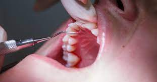 I he bone is reduced in height, but the bone margin remains roughly perpendicular to the tooth surface. How To Reverse Periodontitis