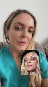 What happened Bebe’s face? #blackeye #facialtrauma #beberexha