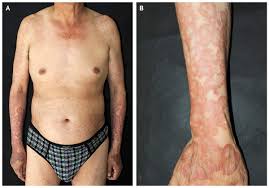 Find patient medical information for ultravate topical on webmd including its uses, side effects and safety, interactions, pictures, warnings and user ratings. Generalized Granuloma Annulare Associated With Diabetes Mellitus Nejm