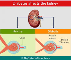 Diabetes And Renal Failure Everything You Need To Know Renal Failure Diabetes Renal