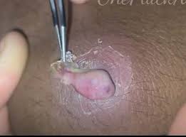 Ingrown hairs occur when a hair grows under the skin or curls around and grows directly into the hair follicle. Ingrown Pubic Hair Cyst Archives New Pimple Popping Videos