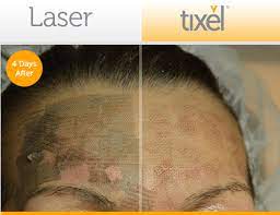 Maybe you would like to learn more about one of these? Tixel London Rejuvenation Lines Acne Scars Eyes Leading Doctors