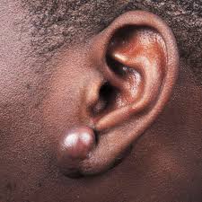 But, you must be careful while. Here S Why Keloid Scars Form And What You Can Do About Them Self