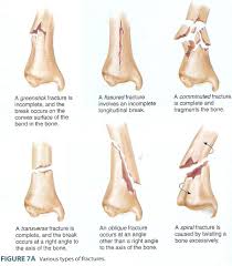 Types Of Bone Fractures Pictures Koibana Info Types Of Bones Bone Fracture Fracture Pictures