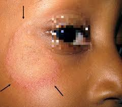Tinea Faciei Wikipedia Infection happens when you have too much yeast, or when it gets into a cut on your skin.