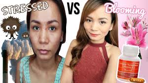 Free radicals are molecules in the environment that damage your skin you should still make sure to get enough of it in your diet, but taking vitamin e supplements doesn't appear to have the same effects on acne. Paano Maging Maganda Myra Vitamin E Benefits Acne Prone Skin Youtube