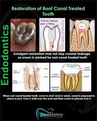 Pin On Dentistry Simplified