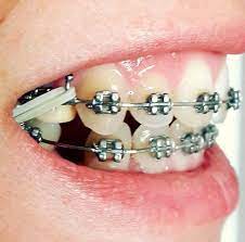 Elastics Braces Girlswithbraces Orthodontics Braces Braces Colors Cute Braces