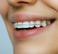 You have braces, and you are thinking of whitening your teeth. Removable Braces Hunslet Dental Surgery