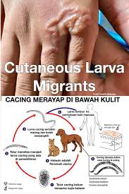 Ini bermakna mereka menumpang hidup dari hidupan yang lain. Public Health Malaysia Seorang Wanita Datang Ke Klinik Dengan Gejala Gatal Di Tangan Selama Seminggu Bermacam Macam Jenis Krim Dan Petua Telah Dilakukan Namun Gejala Gatal Tidak Juga Kurang Pada Waktu