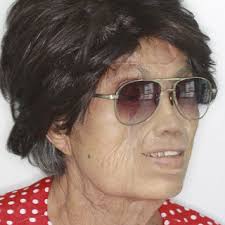 Definitive outcome after facial prosthesis insertion.