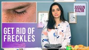 Lemon juice to bleach freckles away lemon juice is one of the best natural bleaches. How To Get Rid Of Freckles Permanently Remedies For Dark Spots Juggun Kazim Beauty Youtube