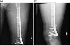 To investigate the effect of masquelet technique combined with artificial dermis on repairing bone and soft tissue defects in rabbits, and to observe the microstructure and vascularization of. Femoral Shaft Nonunions Musculoskeletal Key
