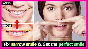 It's often the standard of care when it comes to moderate or severe gummy smiles. 5 Mb 2 Steps How To Fix Narrow Smile And Make Smile Wider Get The Perfect Smile Smile Exercises Download Lagu Mp3 Gratis Mp3 Dragon