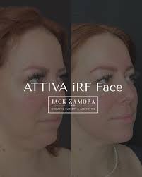 Lower face goals, 𝘢𝘤𝘩𝘪𝘦𝘷𝘦𝘥 ✨ This beautiful result comes from a  combination approach: ATTIVA iRF for the lower face, chin lipo, and a  suture lift. Together, they help refine contours and enhance