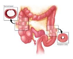 Image result for Radiation Colitis