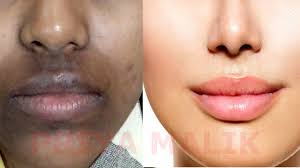 The dark spots can be moles, birthmarks, burn marks, or skin discoloration. How To Remove Dark Black Patches Dark Spots Hyper Pigmentation Around Your Mouth Priya Malik Youtube