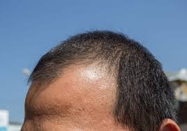 Traction alopecia is hair loss as a result of injuries sudden or chronic to the scalp and hair follicle. Types Of Hair Loss And Their Causes