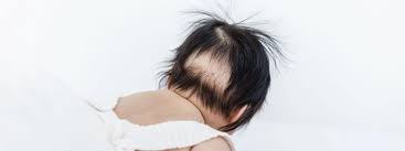 Vellus hair covers most parts of your body, some of which later grow into. How To Stop Baby Bald Spots Silky Tots