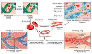 Salmonella Osteomyelitis In Sickle Cell Disease Epomedicine